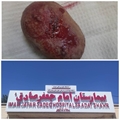 جراحی موفق سنگ مثانه در بیمارستان امام جعفر صادق(ع) پاسارگاد